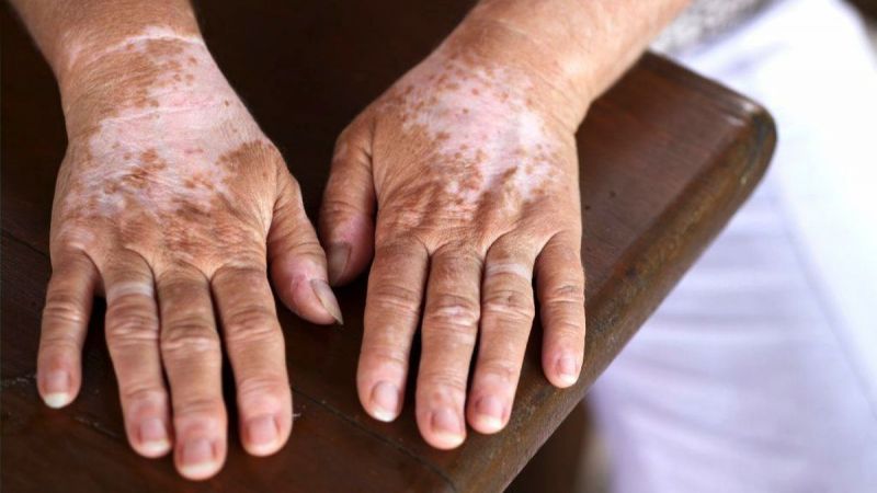 کمبود چه ویتامینی باعث پیسی میشود؟