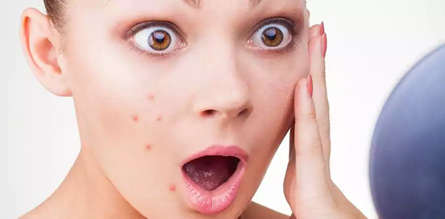 چگونه از آکنه یا جوش پوست جلوگیری کنیم؟